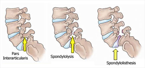 lumbar spine stress fracture anatomy